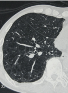 慢性閉塞性肺疾患（ＣＯＰＤ）のＣＴ写真